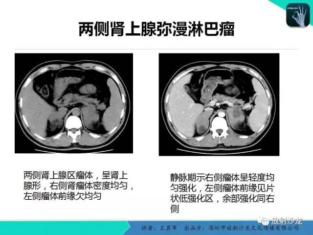 【PPT】肾上腺恶性肿瘤CT诊断