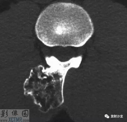【病例】腰3棘突骨软骨瘤1例CT