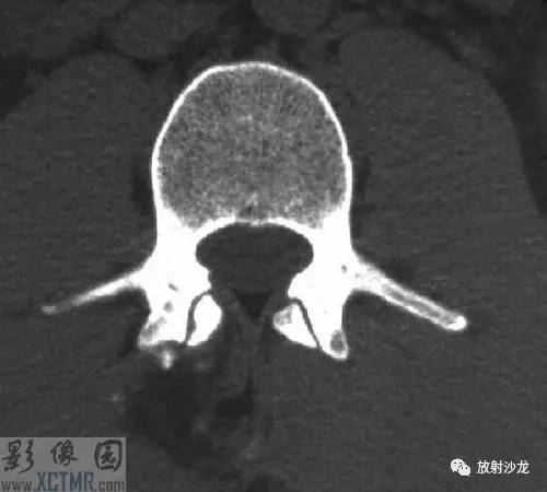 【病例】腰3棘突骨软骨瘤1例CT 【病例】腰3棘突骨软骨瘤1例CT