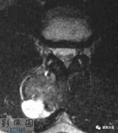 【病例】腰3棘突骨软骨瘤1例CT