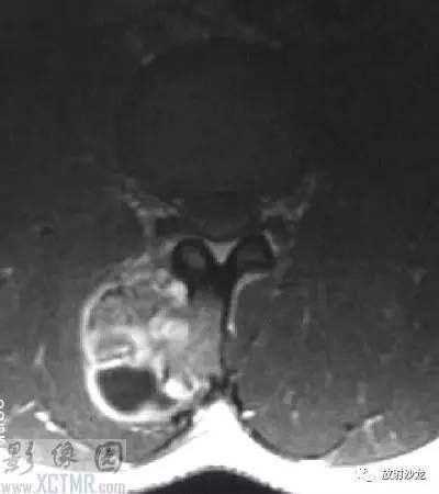 【病例】腰3棘突骨软骨瘤1例CT 【病例】腰3棘突骨软骨瘤1例CT