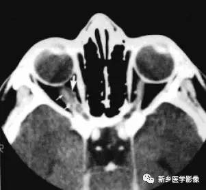 看到视神经增粗,你应该想到的13种病变 看到视神经增粗,你应该想到的13种病变