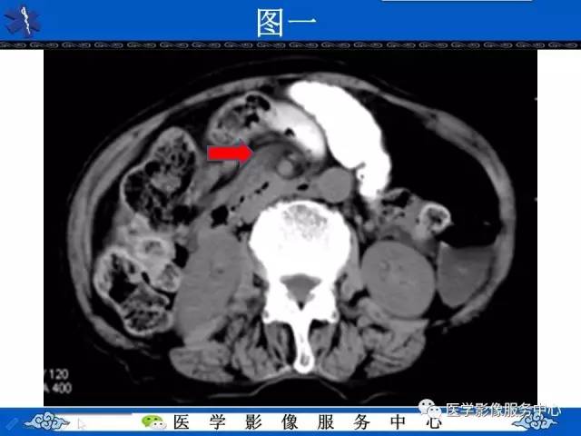 【影像征象】漩涡征