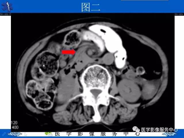 【影像征象】漩涡征