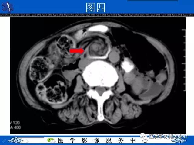 【影像征象】漩涡征