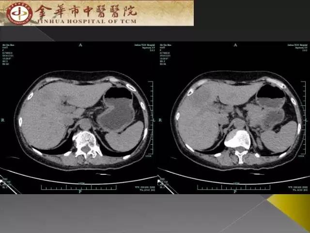 【病例】周围型胆管细胞癌1例CT及MR影像表现 【病例】周围型胆管细胞癌1例CT及MR影像表现