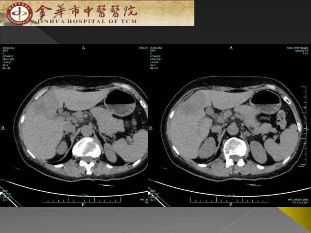 【病例】周围型胆管细胞癌1例CT及MR影像表现 【病例】周围型胆管细胞癌1例CT及MR影像表现