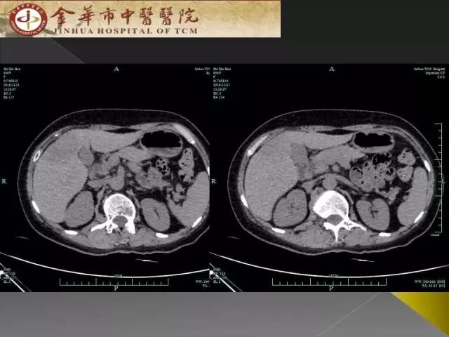 【病例】周围型胆管细胞癌1例CT及MR影像表现 【病例】周围型胆管细胞癌1例CT及MR影像表现