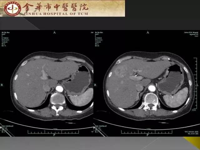 【病例】周围型胆管细胞癌1例CT及MR影像表现 【病例】周围型胆管细胞癌1例CT及MR影像表现