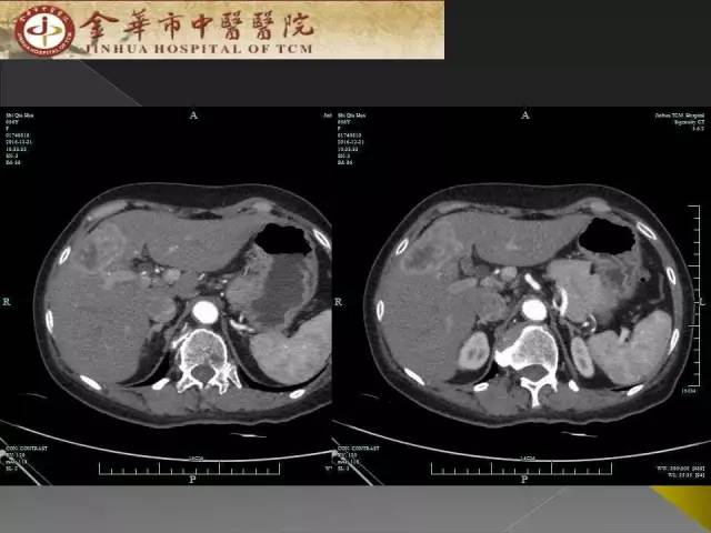 【病例】周围型胆管细胞癌1例CT及MR影像表现 【病例】周围型胆管细胞癌1例CT及MR影像表现