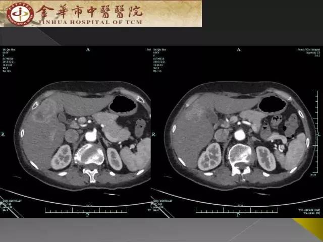 【病例】周围型胆管细胞癌1例CT及MR影像表现 【病例】周围型胆管细胞癌1例CT及MR影像表现