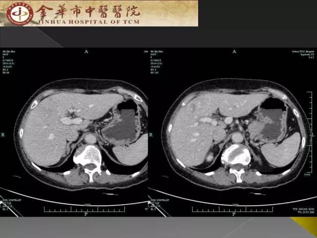 【病例】周围型胆管细胞癌1例CT及MR影像表现 【病例】周围型胆管细胞癌1例CT及MR影像表现