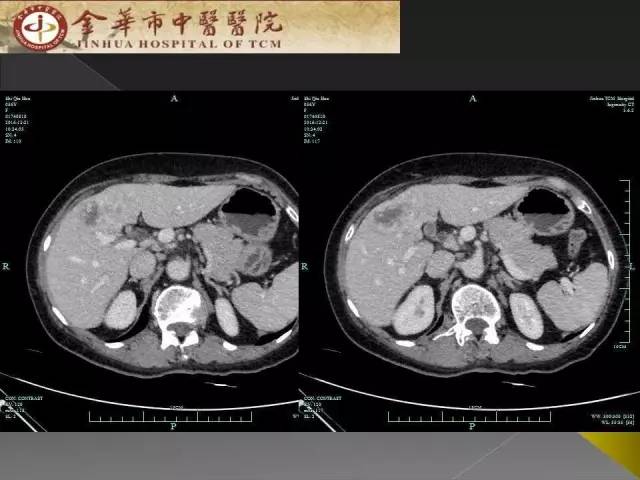 【病例】周围型胆管细胞癌1例CT及MR影像表现 【病例】周围型胆管细胞癌1例CT及MR影像表现