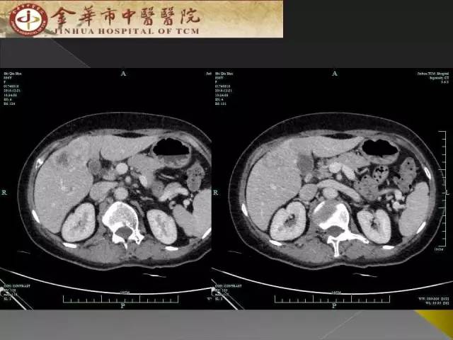 【病例】周围型胆管细胞癌1例CT及MR影像表现 【病例】周围型胆管细胞癌1例CT及MR影像表现