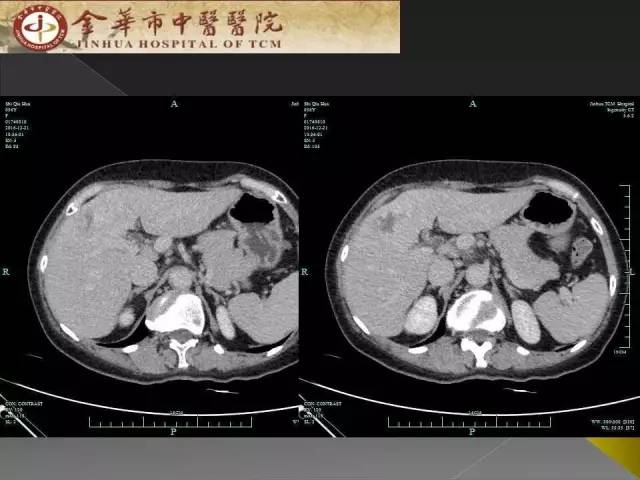 【病例】周围型胆管细胞癌1例CT及MR影像表现 【病例】周围型胆管细胞癌1例CT及MR影像表现