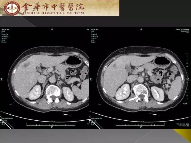 【病例】周围型胆管细胞癌1例CT及MR影像表现 【病例】周围型胆管细胞癌1例CT及MR影像表现
