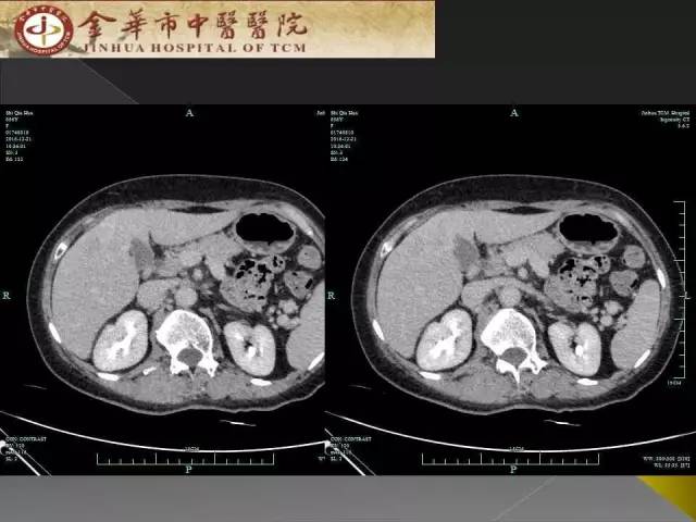 【病例】周围型胆管细胞癌1例CT及MR影像表现 【病例】周围型胆管细胞癌1例CT及MR影像表现