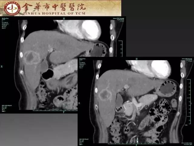 【病例】周围型胆管细胞癌1例CT及MR影像表现 【病例】周围型胆管细胞癌1例CT及MR影像表现
