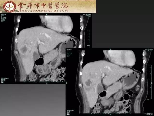 【病例】周围型胆管细胞癌1例CT及MR影像表现 【病例】周围型胆管细胞癌1例CT及MR影像表现