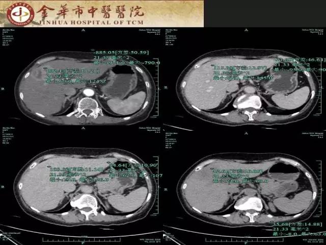 【病例】周围型胆管细胞癌1例CT及MR影像表现 【病例】周围型胆管细胞癌1例CT及MR影像表现