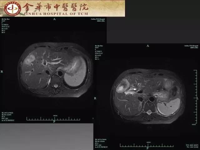 【病例】周围型胆管细胞癌1例CT及MR影像表现 【病例】周围型胆管细胞癌1例CT及MR影像表现