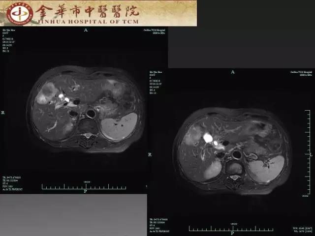 【病例】周围型胆管细胞癌1例CT及MR影像表现 【病例】周围型胆管细胞癌1例CT及MR影像表现