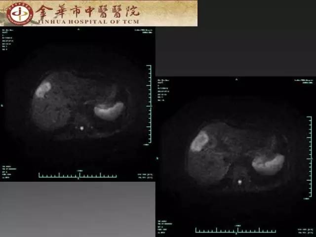 【病例】周围型胆管细胞癌1例CT及MR影像表现 【病例】周围型胆管细胞癌1例CT及MR影像表现