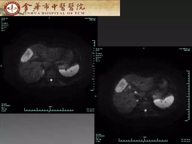【病例】周围型胆管细胞癌1例CT及MR影像表现 【病例】周围型胆管细胞癌1例CT及MR影像表现
