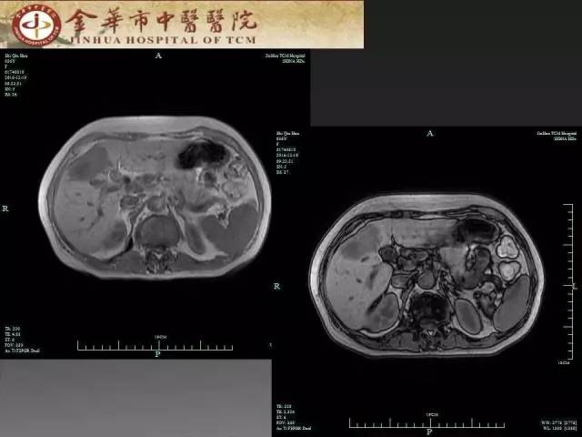 【病例】周围型胆管细胞癌1例CT及MR影像表现 【病例】周围型胆管细胞癌1例CT及MR影像表现