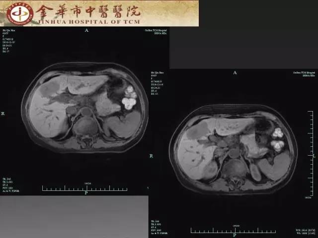【病例】周围型胆管细胞癌1例CT及MR影像表现 【病例】周围型胆管细胞癌1例CT及MR影像表现