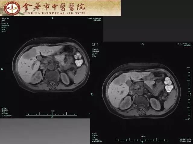 【病例】周围型胆管细胞癌1例CT及MR影像表现 【病例】周围型胆管细胞癌1例CT及MR影像表现