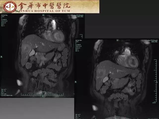 【病例】周围型胆管细胞癌1例CT及MR影像表现 【病例】周围型胆管细胞癌1例CT及MR影像表现