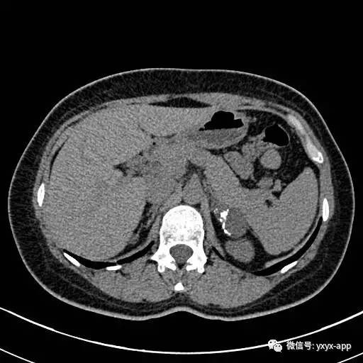 【病例】左侧肾上腺假性囊肿伴钙化1例CT