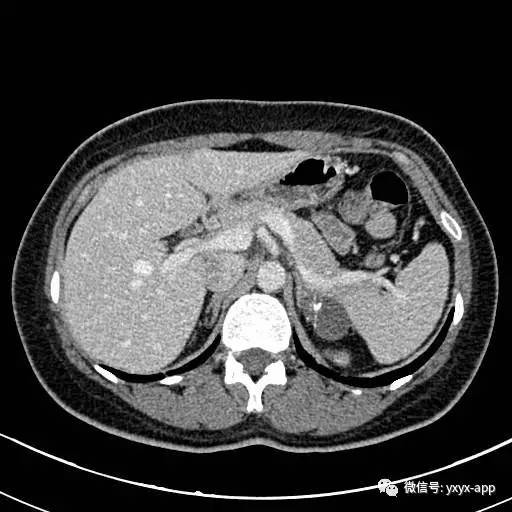 【病例】左侧肾上腺假性囊肿伴钙化1例CT 【病例】左侧肾上腺假性囊肿伴钙化1例CT