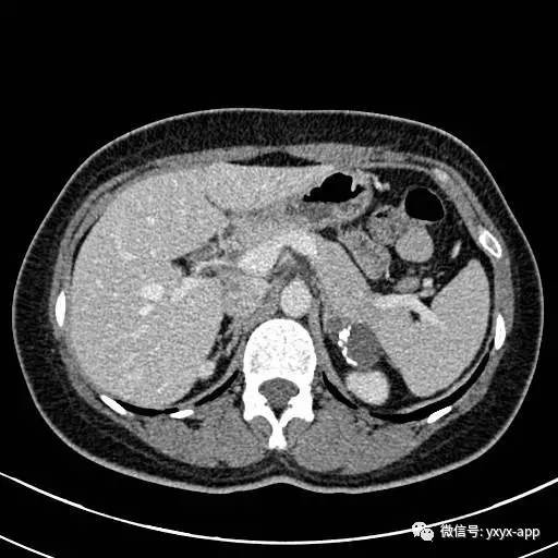 【病例】左侧肾上腺假性囊肿伴钙化1例CT 【病例】左侧肾上腺假性囊肿伴钙化1例CT