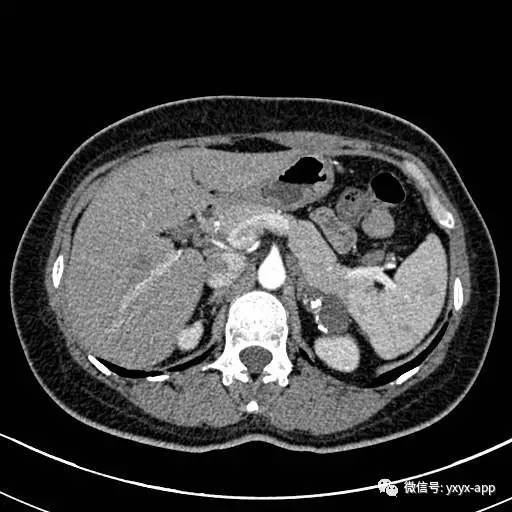 【病例】左侧肾上腺假性囊肿伴钙化1例CT 【病例】左侧肾上腺假性囊肿伴钙化1例CT