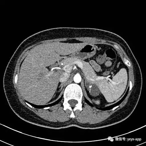 【病例】左侧肾上腺假性囊肿伴钙化1例CT 【病例】左侧肾上腺假性囊肿伴钙化1例CT