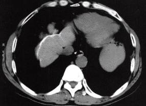 【病例】慢性血吸虫性肝病1例CT 【病例】慢性血吸虫性肝病1例CT
