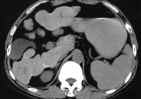 【病例】慢性血吸虫性肝病1例CT 【病例】慢性血吸虫性肝病1例CT