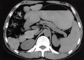 【病例】慢性血吸虫性肝病1例CT 【病例】慢性血吸虫性肝病1例CT