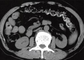 【病例】慢性血吸虫性肝病1例CT 【病例】慢性血吸虫性肝病1例CT
