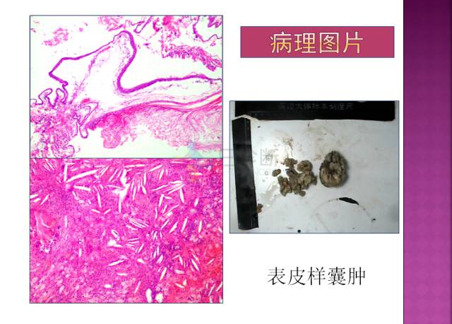 【病例】四脑室内表皮样囊肿1例MR分析思路
