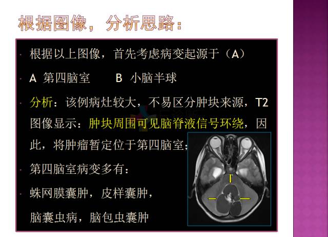 【病例】四脑室内表皮样囊肿1例MR分析思路