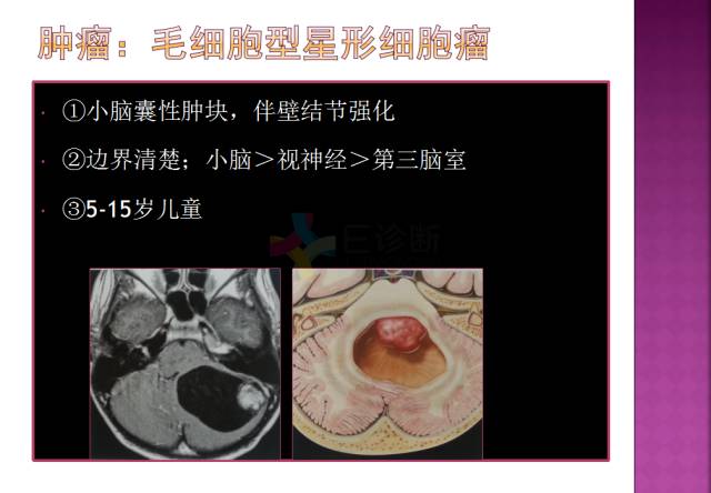【病例】四脑室内表皮样囊肿1例MR分析思路
