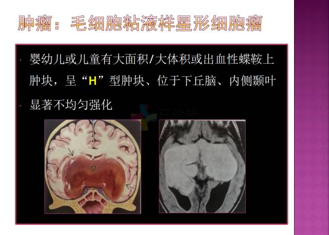【病例】四脑室内表皮样囊肿1例MR分析思路