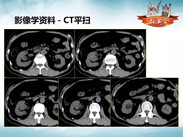 【病例】右肾血管瘤1例CT影像表现