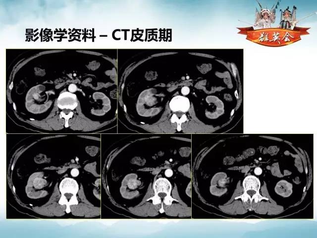 【病例】右肾血管瘤1例CT影像表现