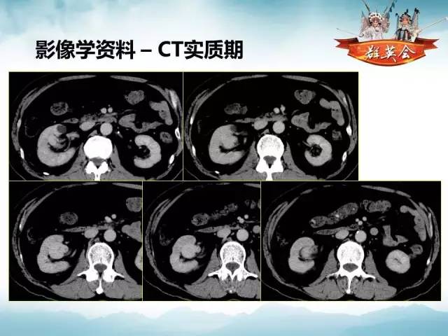 【病例】右肾血管瘤1例CT影像表现