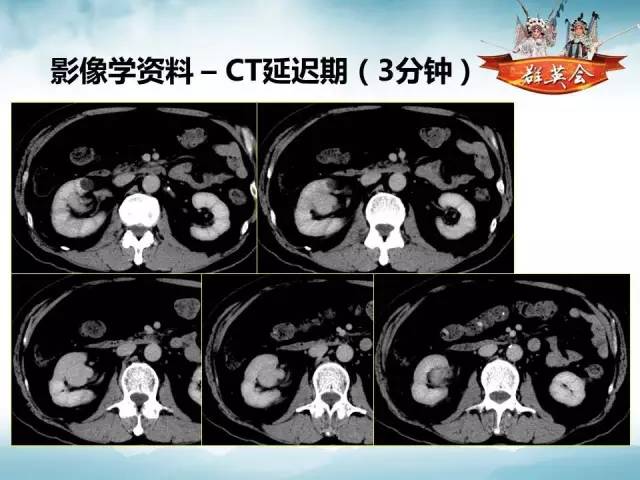【病例】右肾血管瘤1例CT影像表现