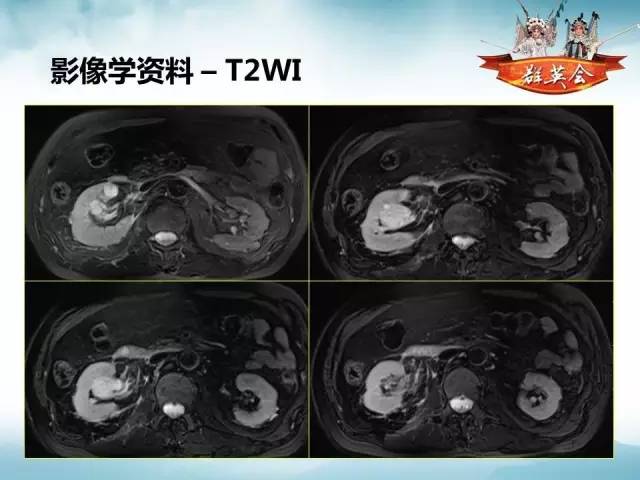 【病例】右肾血管瘤1例CT影像表现